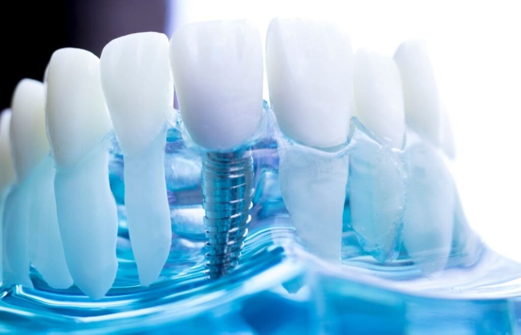 implantes dentales en tijuana